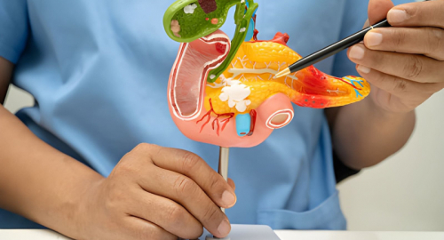 Tumore del pancreas, FDA approva Rasonque: svolta nella terapia mirata
